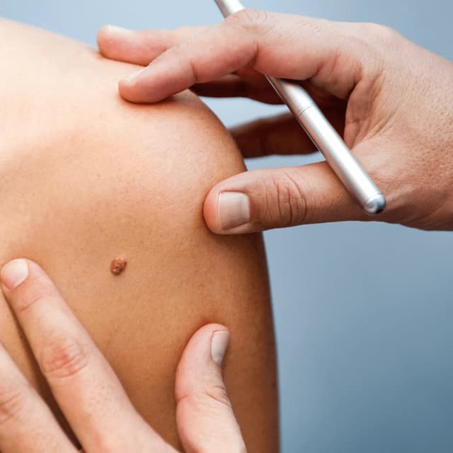 One Imperfection Removal Bundle at Ultimate Health Spa in Leesburg, FL